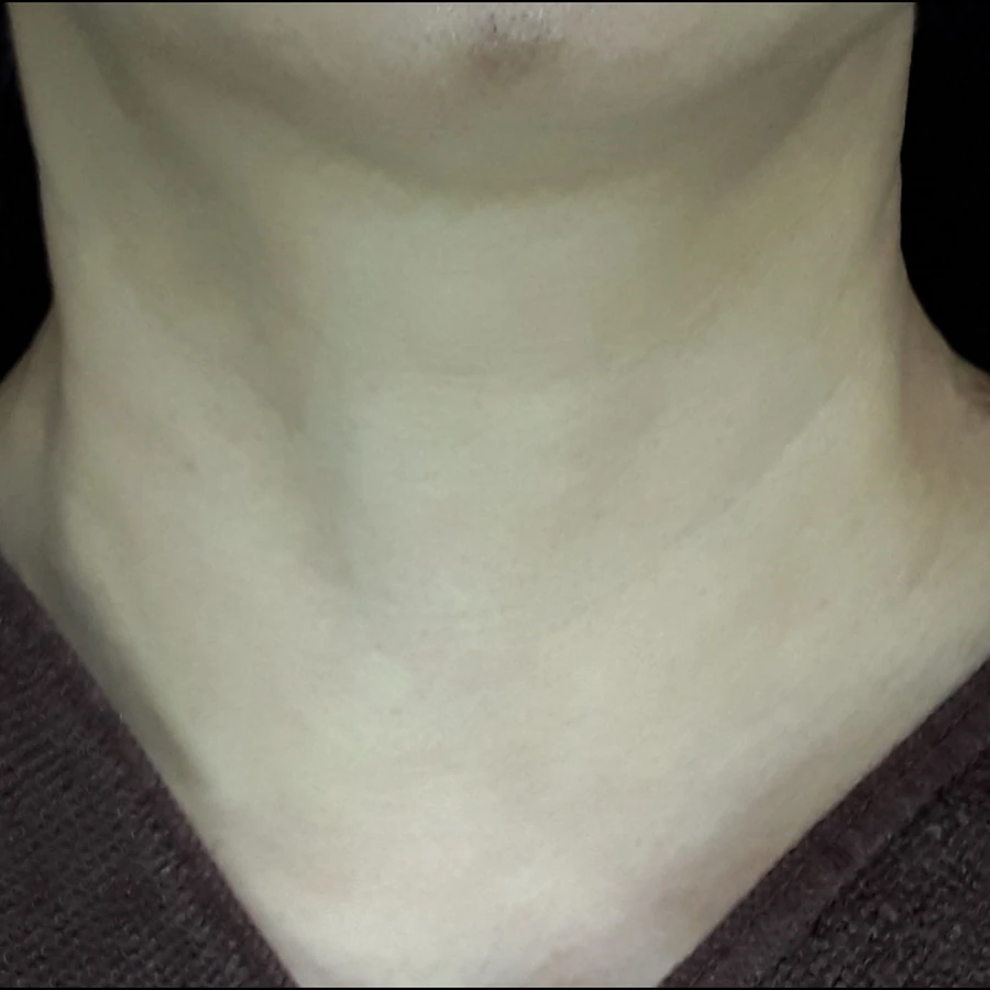 After view for case 04