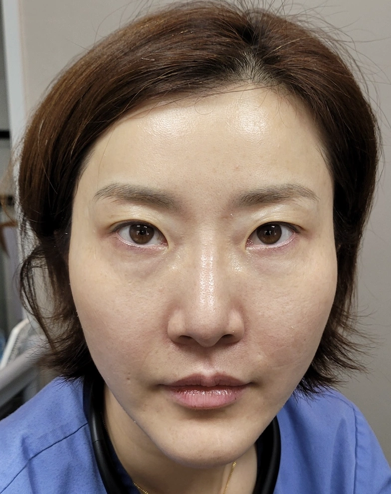 3D Facial Balance — Early follow-up · approximately 2 weeks