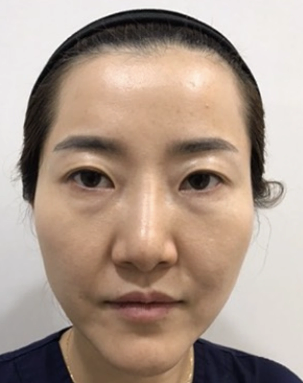 3D Facial Balance — Before · 2018